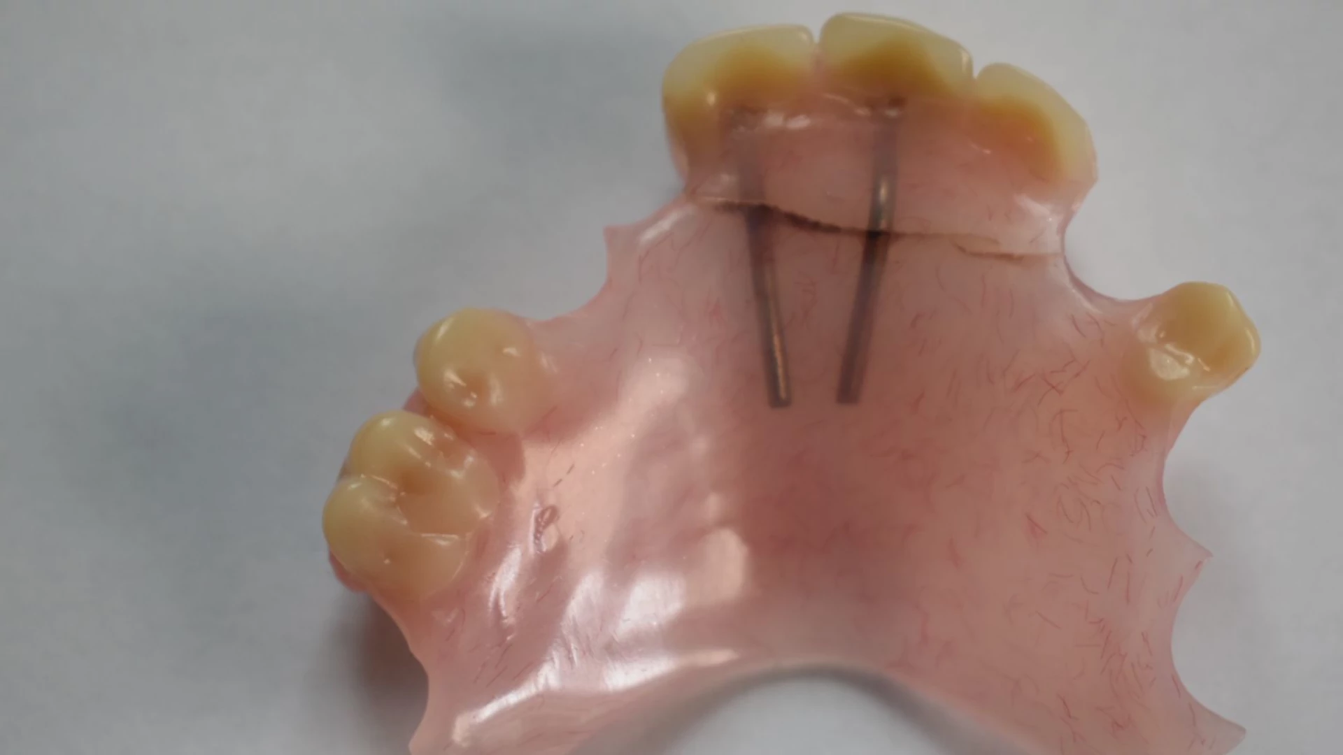 Denture Repairs 365 - Dental Broken Denture Repairs 365 - Dental Broken