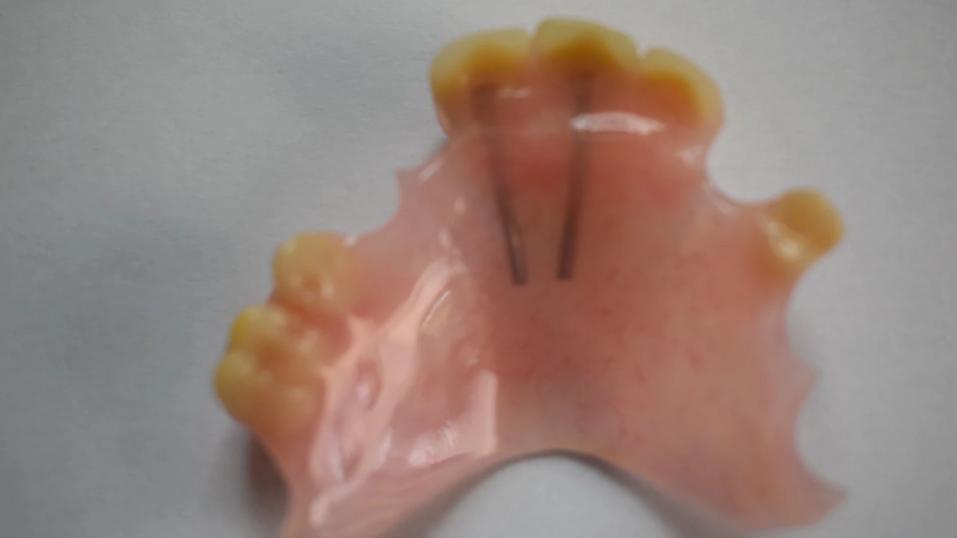Denture Repairs 365 - Dental Repaired Denture Repairs 365 - Dental Broken